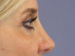 Eyelid Surgery Before and after photo