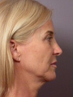 Eyelid Surgery Before and after photo