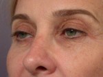 Eyelid Surgery Before and after photo