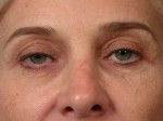 Eyelid Surgery Before and after photo