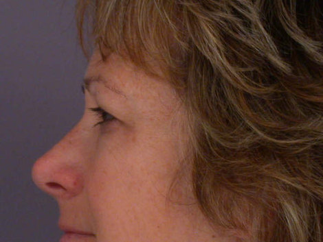 Eyelid Surgery before and after photo