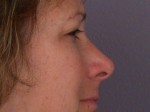 Eyelid Surgery Before and after photo