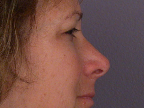 Eyelid Surgery before and after photo