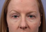 Eyelid Surgery Before and after photo