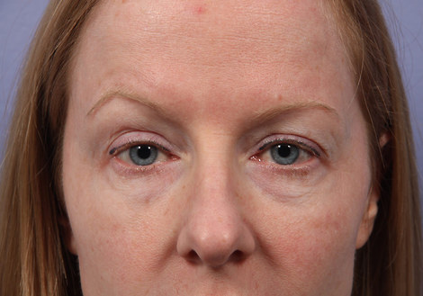 Eyelid Surgery before and after photo