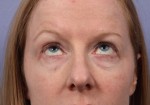 Eyelid Surgery Before and after photo