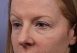 Eyelid Surgery Before and after photo