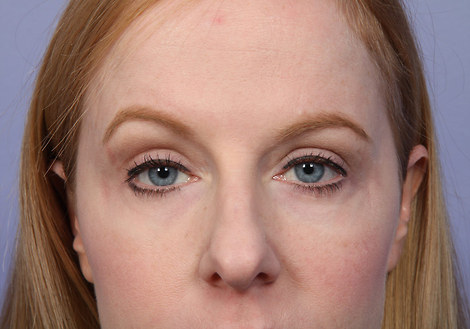 Eyelid Surgery before and after photo