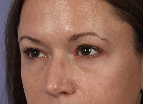 Eyelid Surgery before and after photo