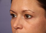 Eyelid Surgery Before and after photo