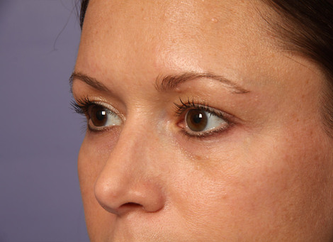 Eyelid Surgery before and after photo