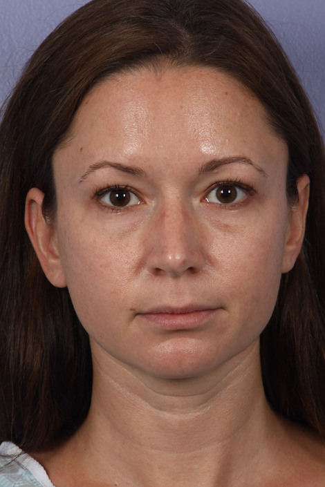 Eyelid Surgery before and after photo