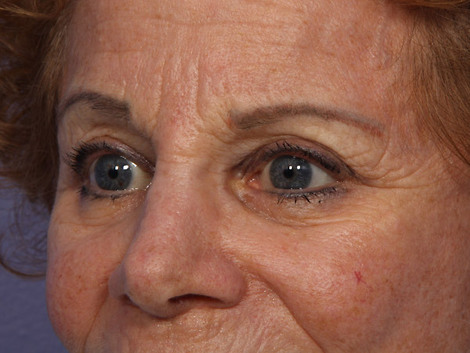 Eyelid Surgery before and after photo