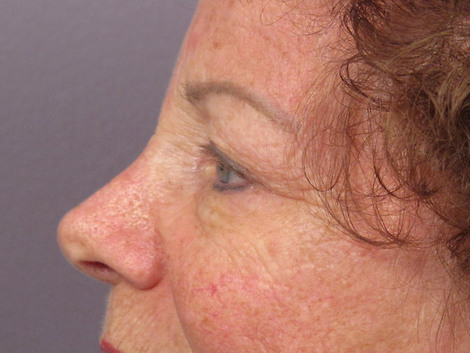 Eyelid Surgery before and after photo