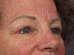 Eyelid Surgery Before and after photo