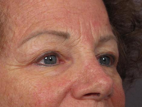 Eyelid Surgery before and after photo