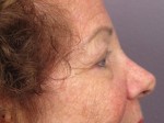 Eyelid Surgery Before and after photo