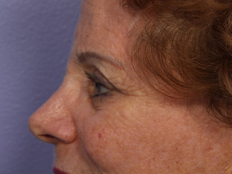 Eyelid Surgery before and after photo