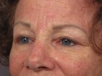 Eyelid Surgery Before and after photo