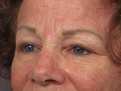 Eyelid Surgery before and after photo