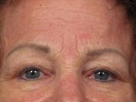 Eyelid Surgery Before and after photo