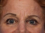 Eyelid Surgery Before and after photo