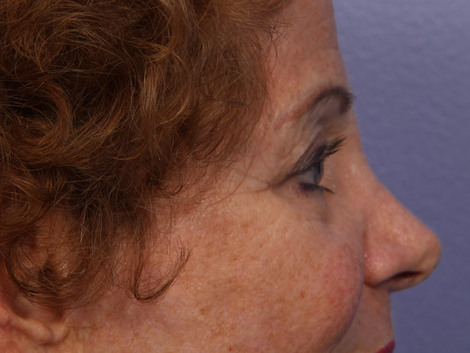 Eyelid Surgery before and after photo