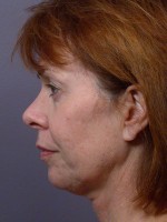 Eyelid Surgery Before and after photo