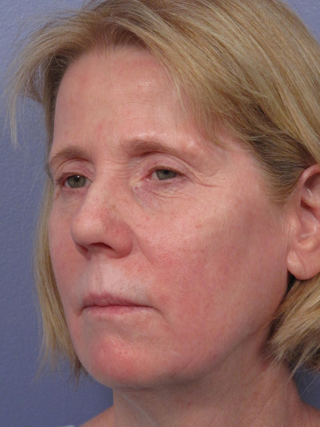 Eyelid Surgery before and after photo