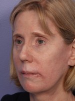 Eyelid Surgery Before and after photo