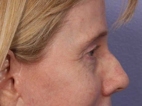 Eyelid Surgery before and after photo