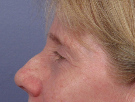 Eyelid Surgery before and after photo