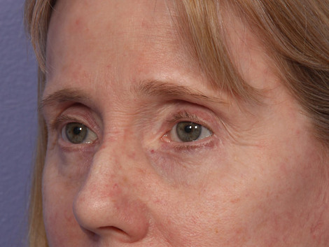 Eyelid Surgery before and after photo