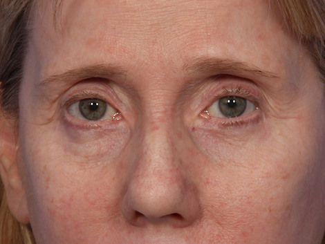 Eyelid Surgery before and after photo