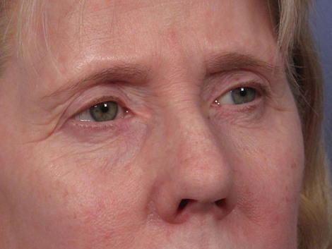 Eyelid Surgery before and after photo