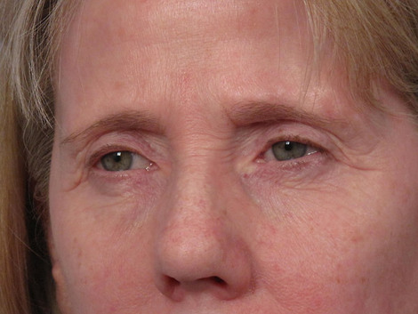 Eyelid Surgery before and after photo