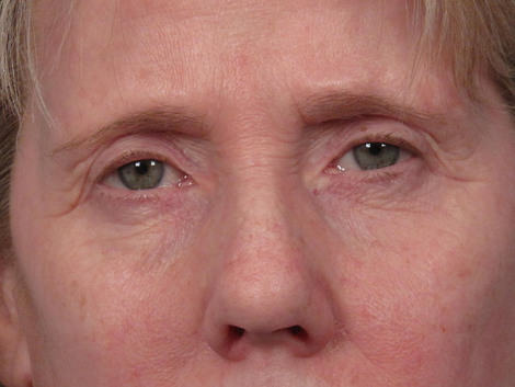 Eyelid Surgery before and after photo