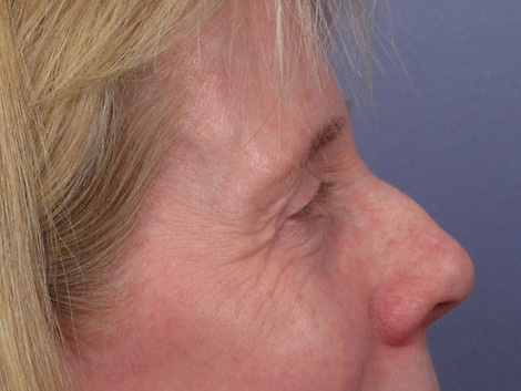 Eyelid Surgery before and after photo