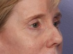 Eyelid Surgery Before and after photo