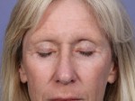 Eyelid Surgery Before and after photo