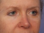 Eyelid Surgery Before and after photo