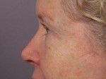 Eyelid Surgery Before and after photo