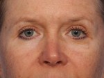 Eyelid Surgery