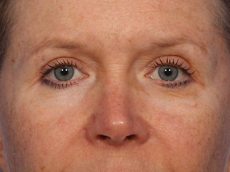 Eyelid Surgery before and after photo