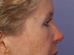 Eyelid Surgery Before and after photo