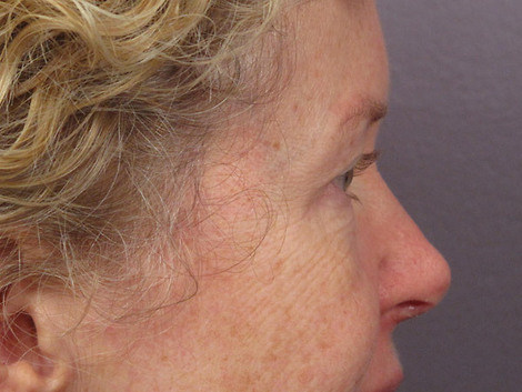 Eyelid Surgery before and after photo