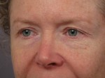 Eyelid Surgery Before and after photo