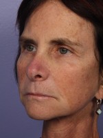 Eyelid Surgery