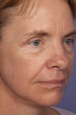 Eyelid Surgery Before and after photo