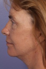 Eyelid Surgery Before and after photo